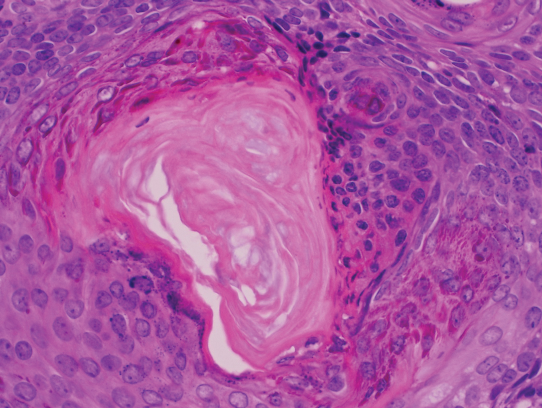 Subcutaneous Nodule on the Chest MDedge Dermatology